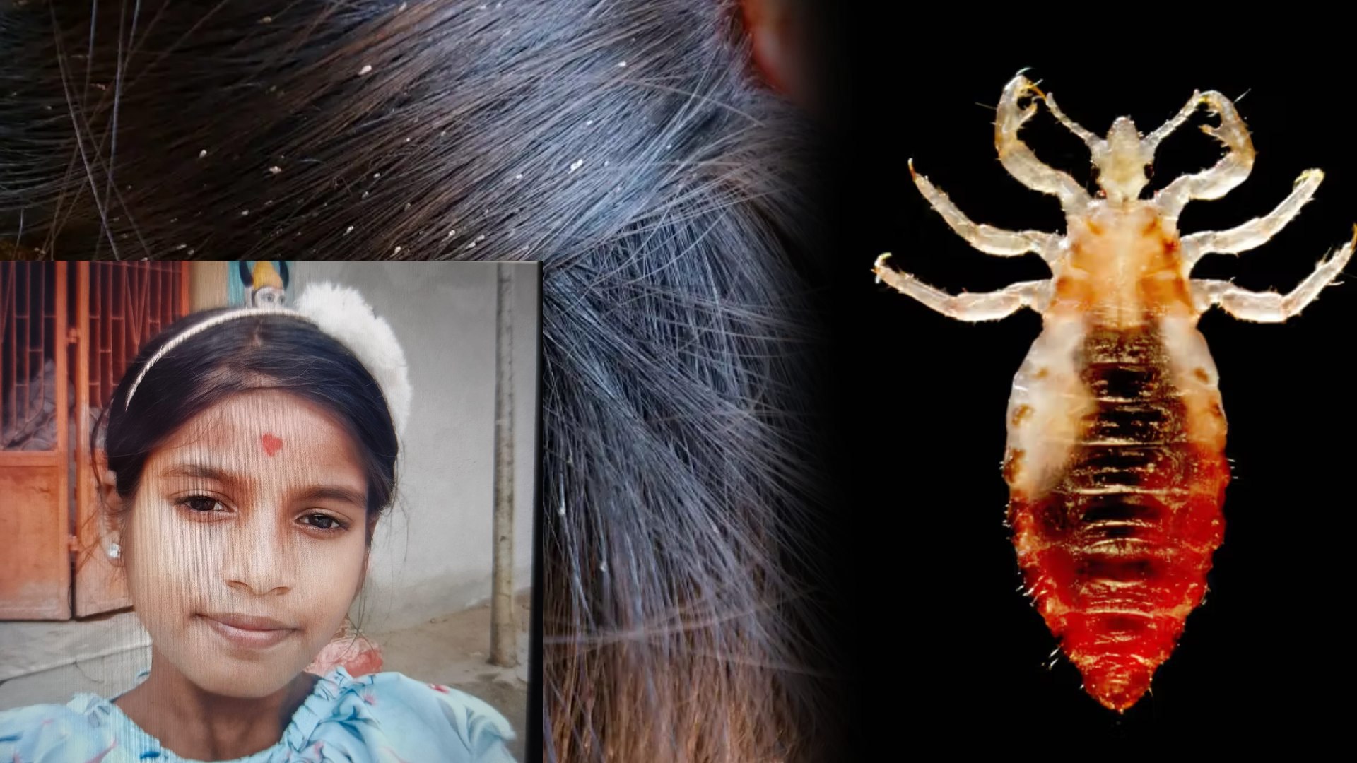 12-Year-Old Odisha Girl Dies After Months of Ignored Lice Infestation in Puri